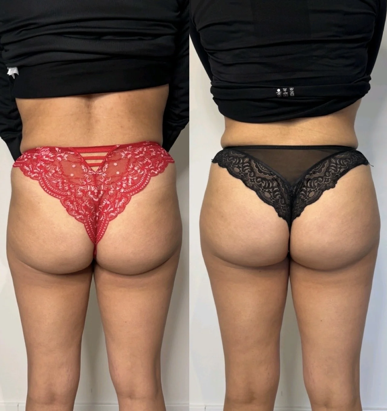 Bilfiller voor en na resultaat - hip dips opvullen
