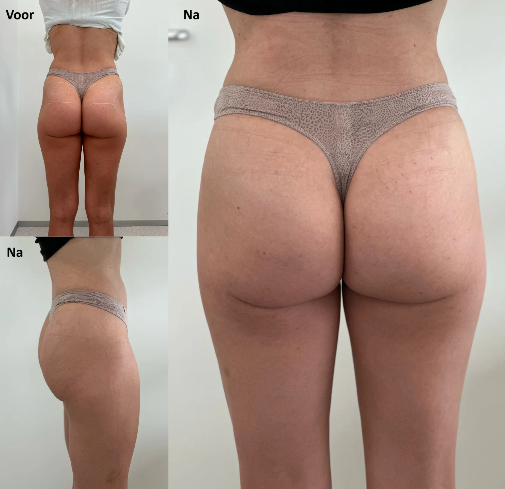 Bilfiller voor en na resultaat - bilvergroting met Lanluma X