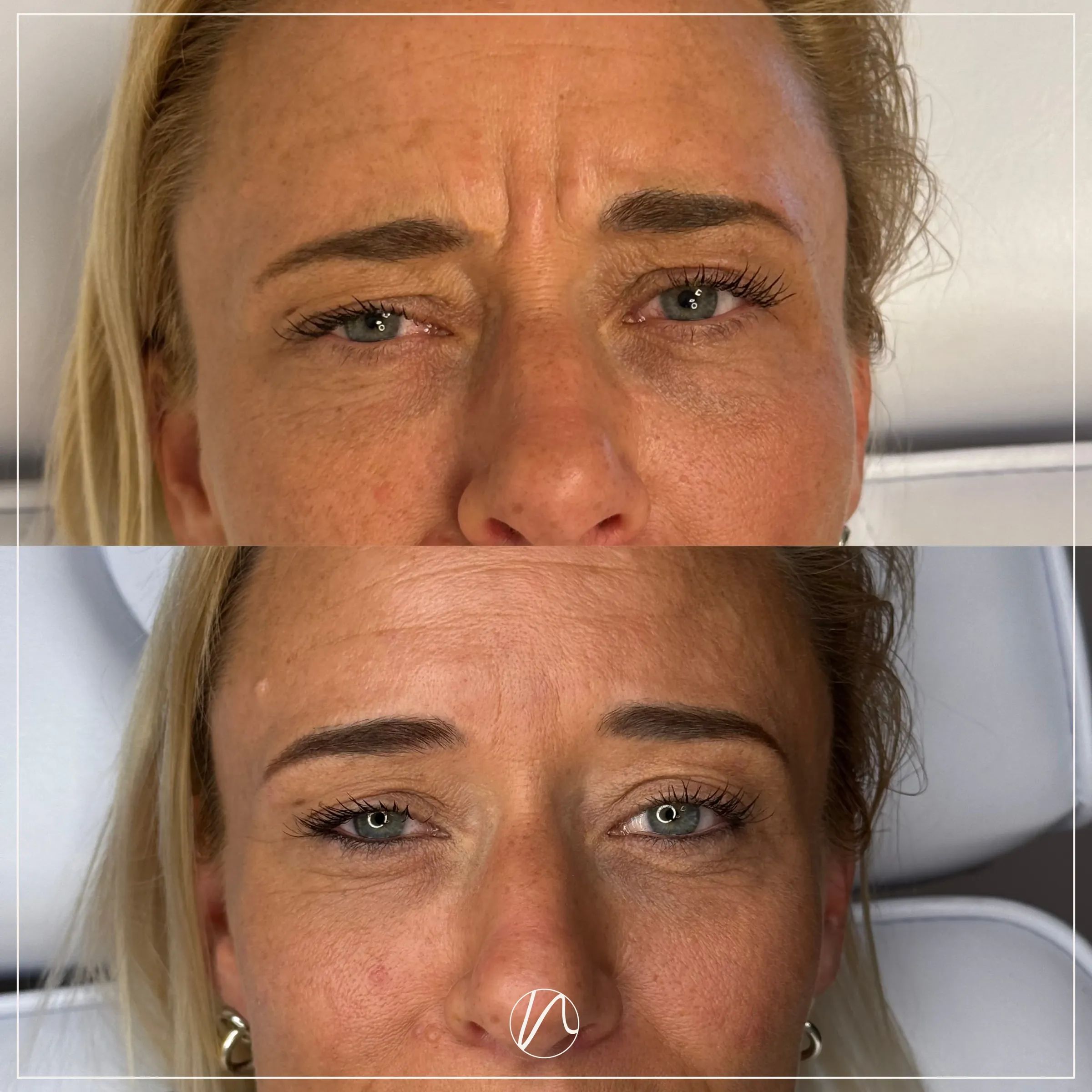 Botox frons resultaat 2 - voor en na
