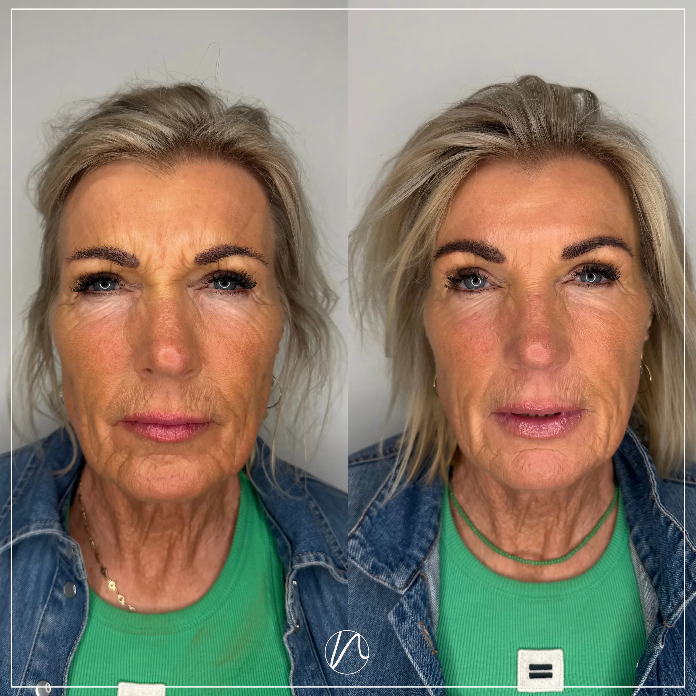 Botox frons resultaat 3 - voor en na