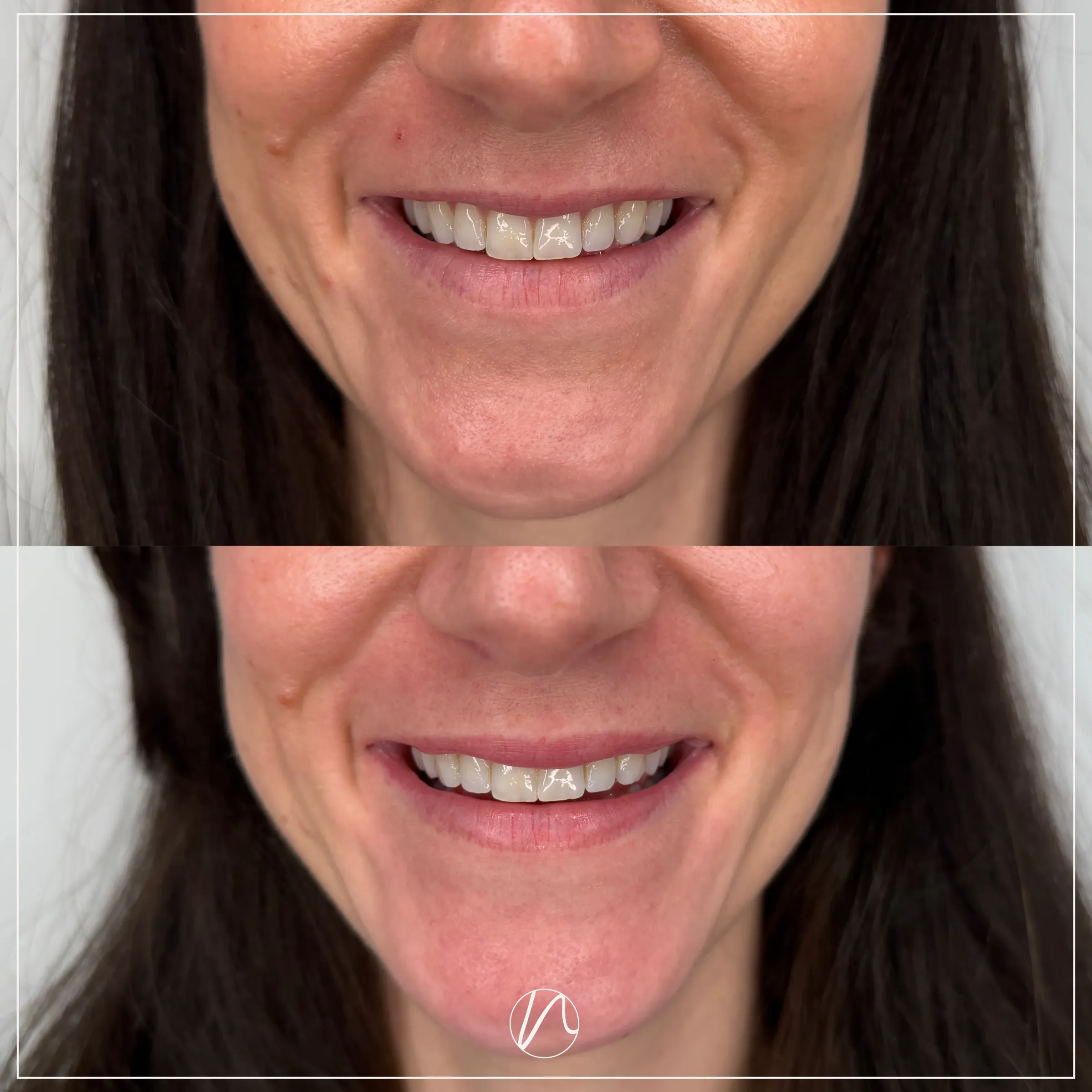 Lip flip resultaat - voor en na
