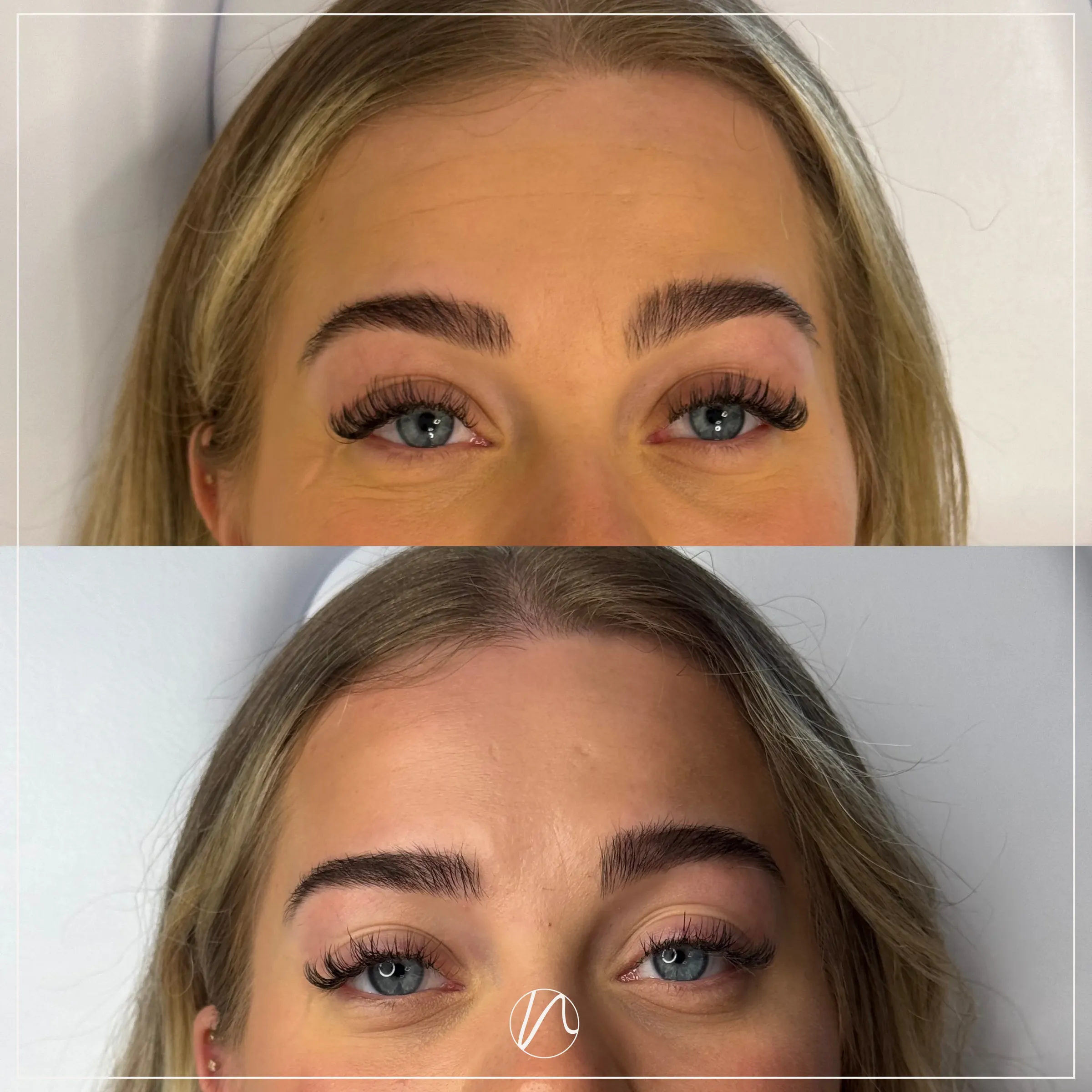 Botox forehead result - before and after