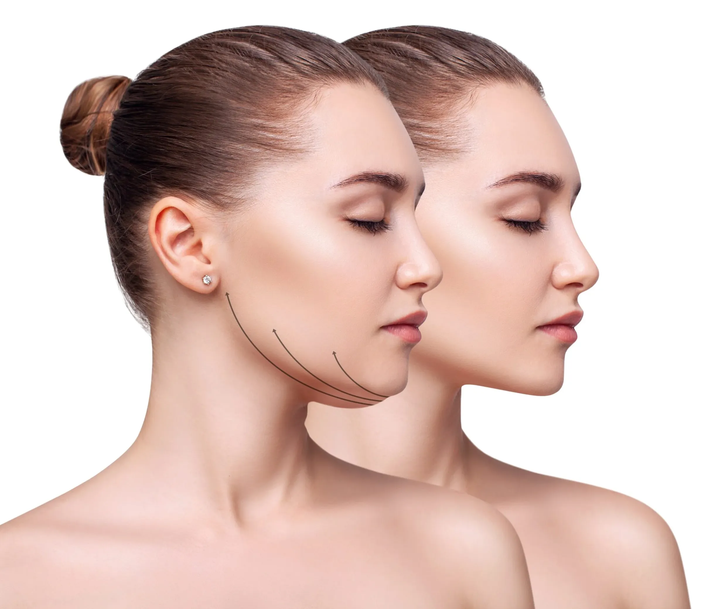 Botox Face Slimming / Teeth Grinding at Noveve Aesthetics
