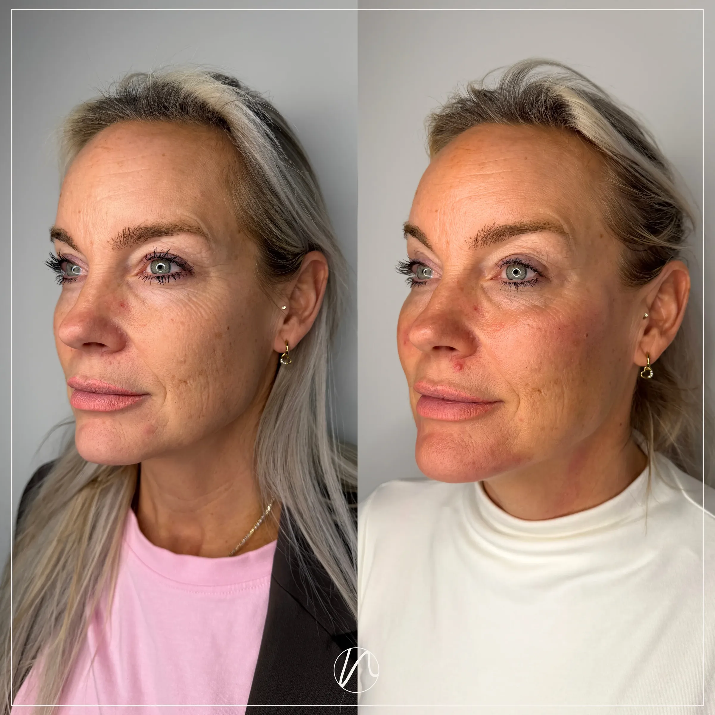 Jukbeenfiller resultaat - voor en na