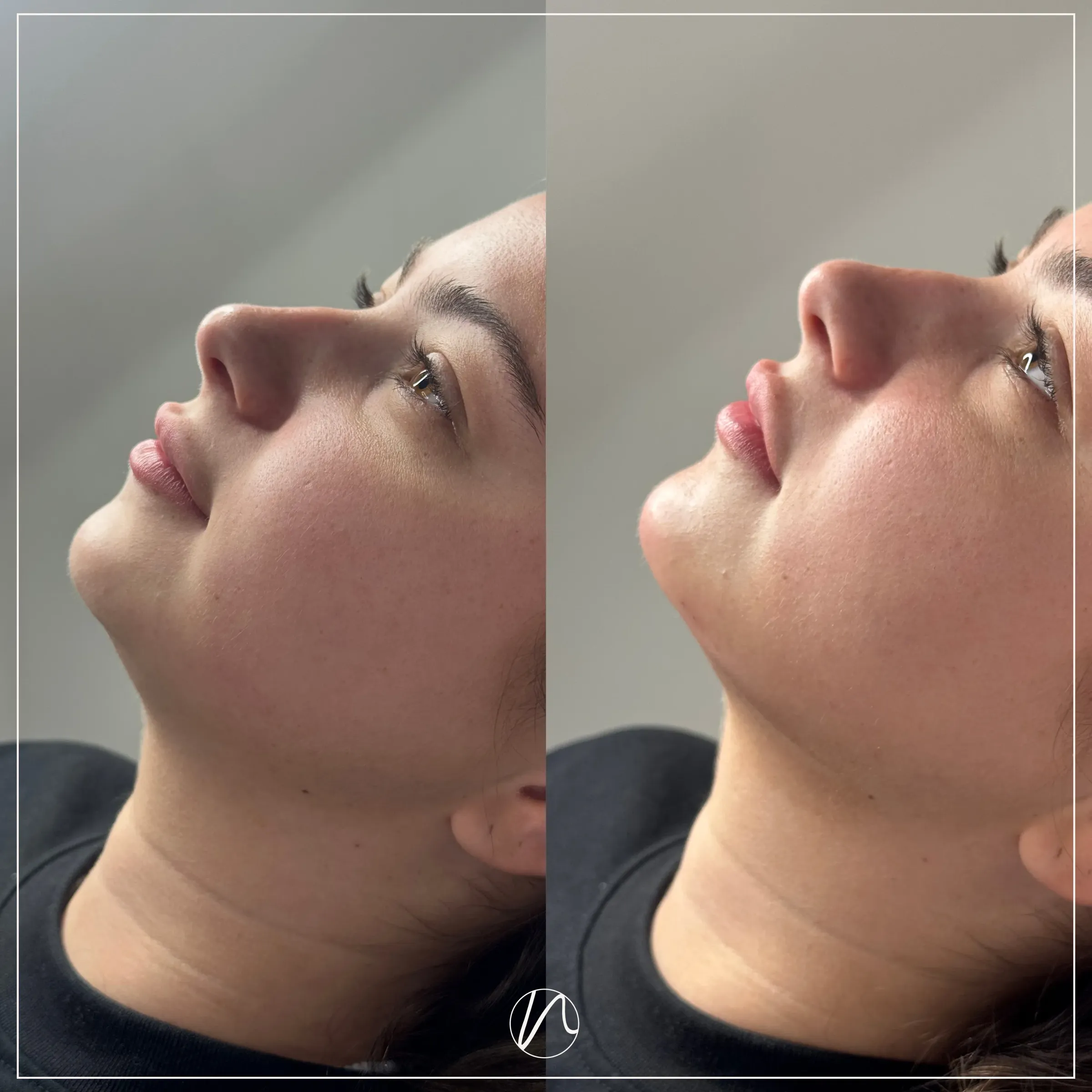Chin filler result 1 - before and after