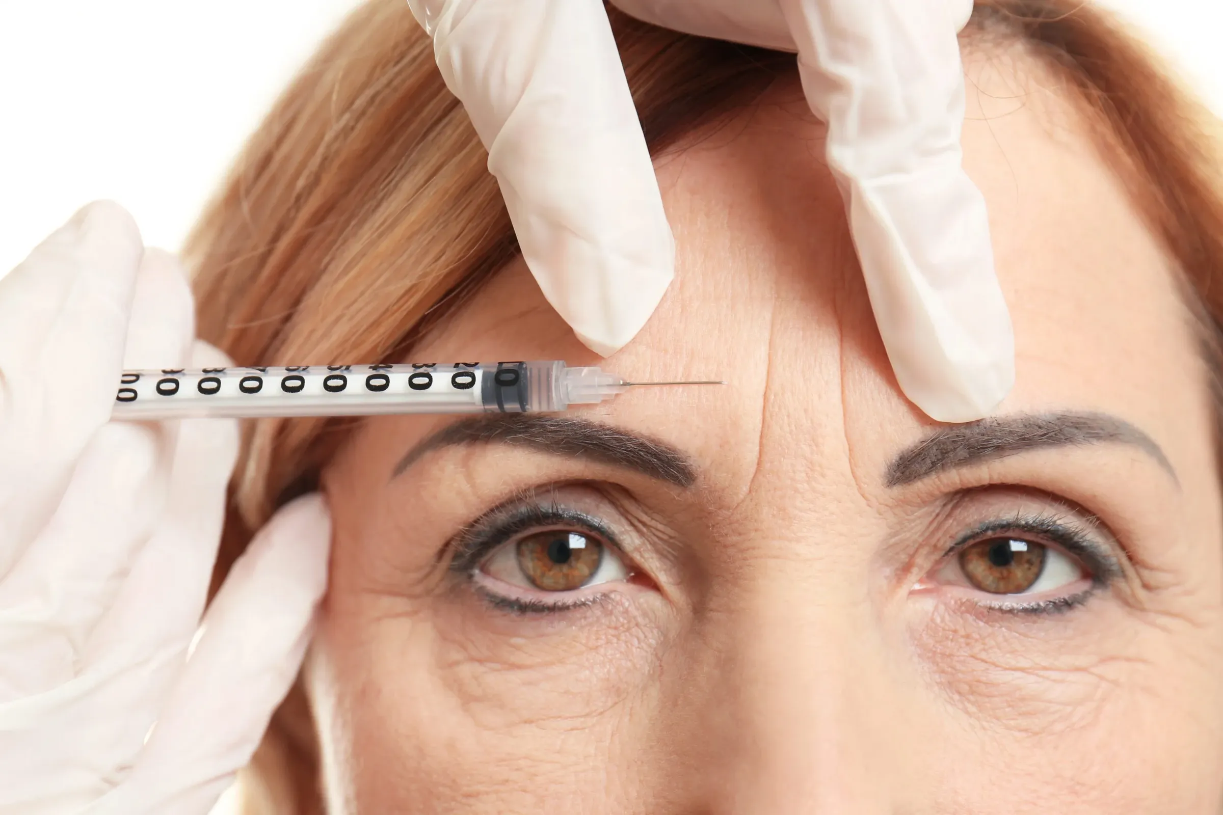 Botox Frons bij Noveve Aesthetics