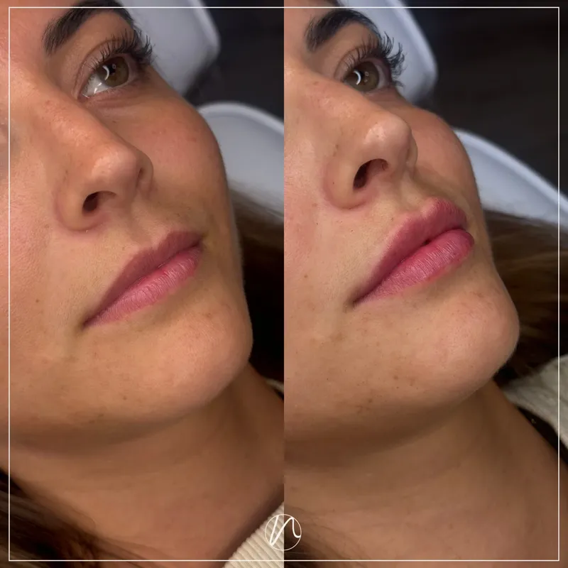 Lipfiller 1.0ml resultaat na 2 weken herstel