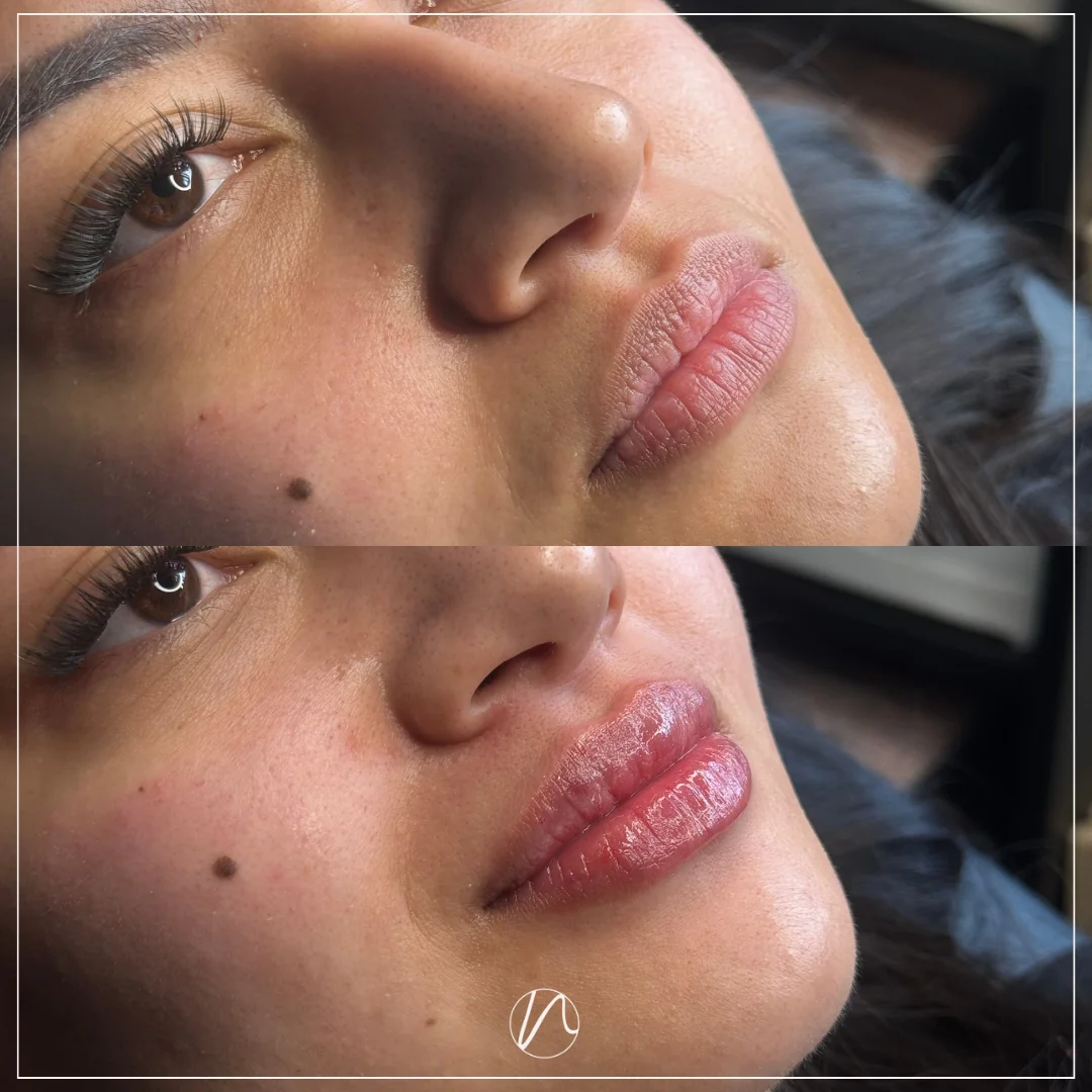 Lipfiller 0.5ml resultaat 2