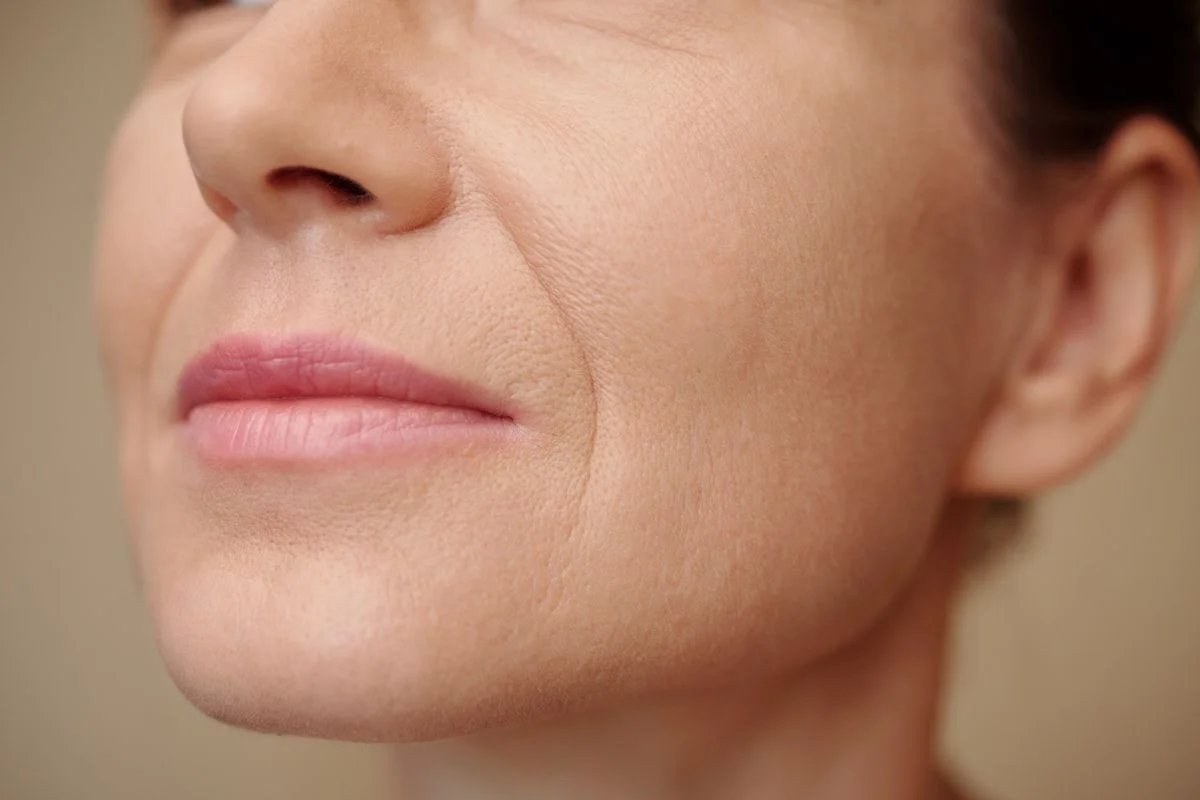 Fillers Neus-lippenplooi bij Noveve Aesthetics
