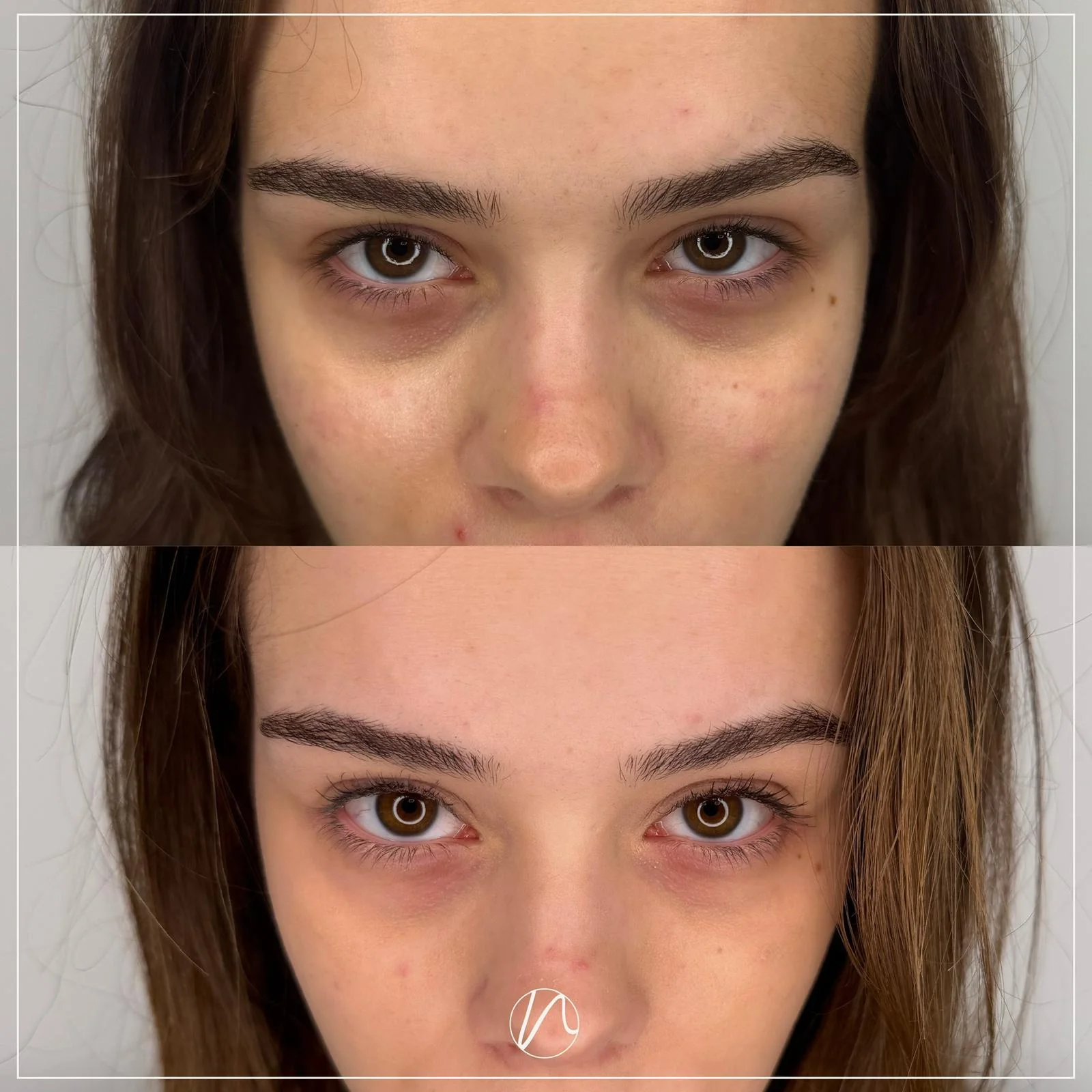 Resultaat polynucleotide Ami Eyes voor en na bij Noveve Aesthetics