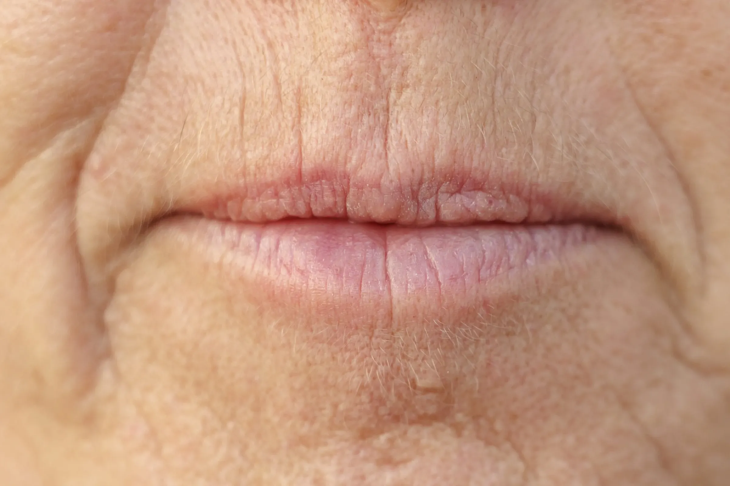 Fillers Rokerslijntjes bij Noveve Aesthetics